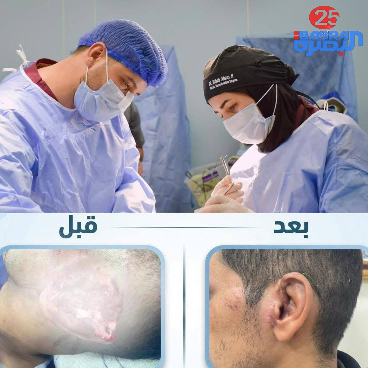 فريق طبي من محافظة ذي قار ينجح بإجراء عملية ترميم كاملة لأذن مبتورة بتراً تاماً لشخص تعرّض لحادث سير، حيث أُعيد ربط الأنسجة المتضررة بنجاح وعادت الأذن إلى وضعها الطبيعي